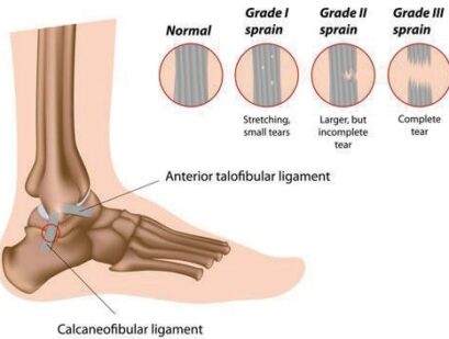 ricer no harm ligament